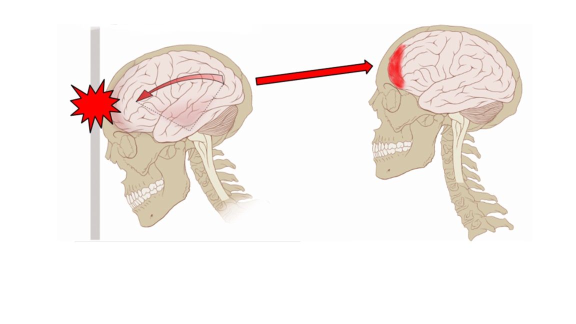 Closed_Brain_Injury_Closed_Head_Injury.jpg