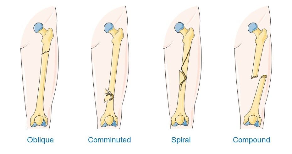 Types_of_fracture.jpg