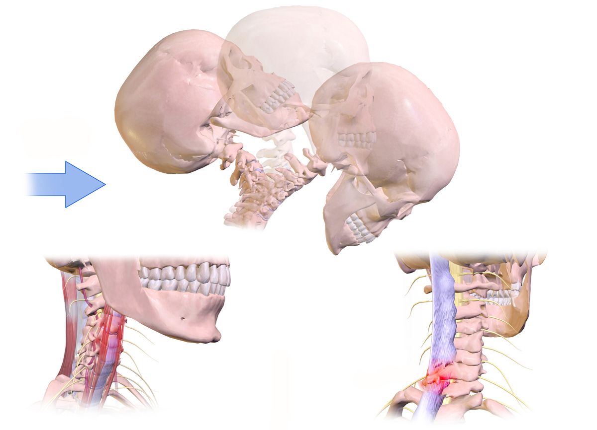 Whiplash_Injury.jpg